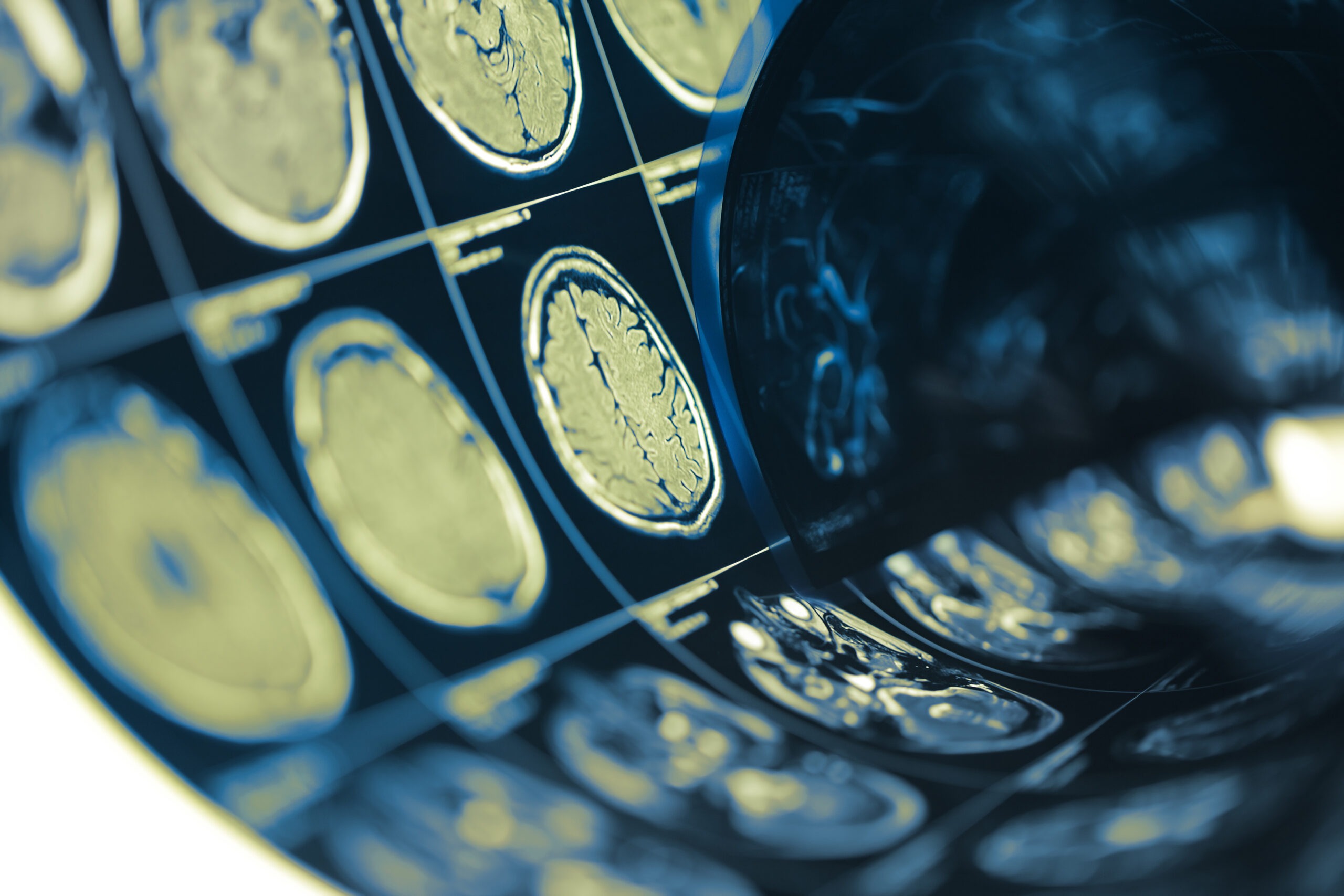 Sangrado Cerebral por un Accidente Automovilístico: Lo Que Significa