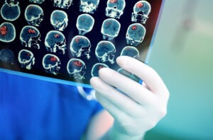 Doctor con la resonancia magnética de un abogado de lesiones cerebrales traumáticas