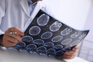 Doctor revisando resonancia magnética de un abogado de lesiones cerebrales