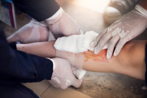 burn victim getting leg wrapped
